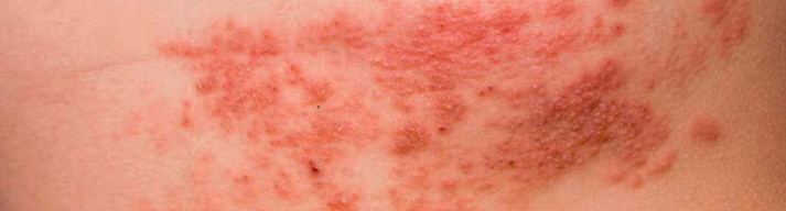 dermatologia-CATEI-Hidradenitis-Supurativa Padecimientos: Hidradenitis Supurativa