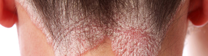 dermatologia-CATEI-Psoriasis Padecimientos: Psoriasis