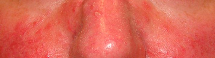 dermatologia-CATEI-Rosacea Padecimientos: Rosacea