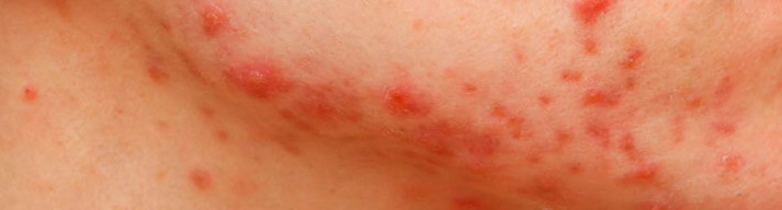 dermatologia-CATEI-acne Padecimientos: Acné