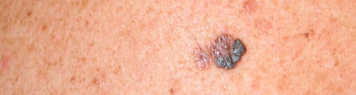 dermatologia-CATEI-cancer-cutaneo Padecimientos: Cancer y Precancer Cutaneo