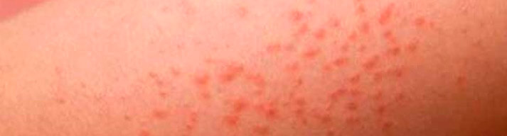 dermatologia-CATEI-dermatitis-atopica Padecimientos: Dermatitis Atópica