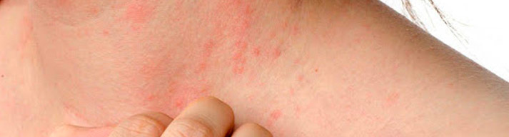 dermatologia-CATEI-ing¡fecciones-cutaneas Padecimientos: Infecciones Cutaneas