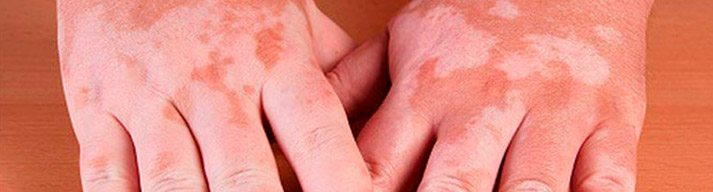 dermatologia-CATEI-padecimientos-transtornos-de-pigmentacion Padecimientos: Trastornos de la pigmentación