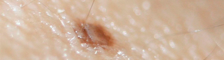 dermatologia-CATEI-tumores-benignos Padecimientos: Tumores Benignos